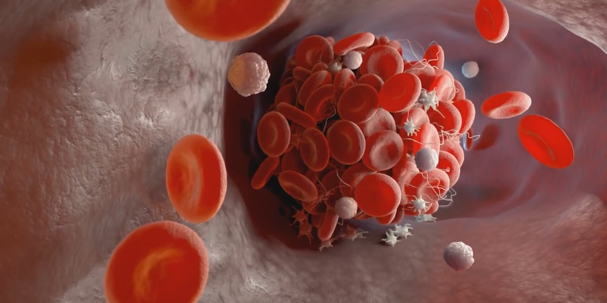 Blood Clot Risks Recognizing the danger of blood clots